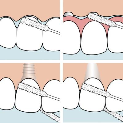 TePe Silta- ja implanttihammaslanka